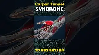 Understanding Carpal Tunnel Syndrome: Causes, Symptoms, and Treatment
