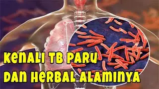 TB Paru, Penyakit Yang Cenderung Terlupakan Selama Pandemi | Obat Herbal Alami dan Testimoninya