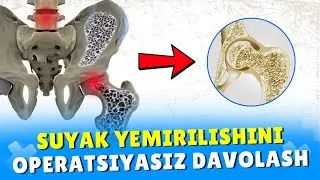 SUYAK YEMIRILISHINI OPERATSIYASIZ DAVOLASH