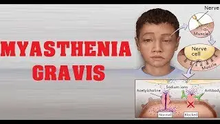 What is Myasthenia Gravis? - Cause and Treatment