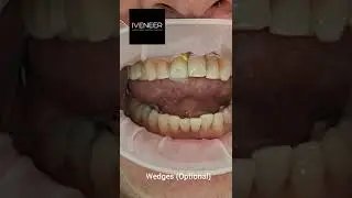 Try In and setting IVENEER