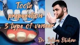 Preparation of teeth for type 3 veneer. Demonstration video. Dr.Islam Shikov.