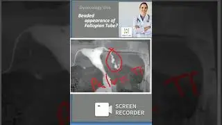Gynecology Beaded Fallopian Tube Tuberculosis PID pelvic