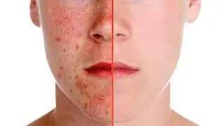Photoshop Tutorial || How to Remove Acne / pimple & make skin smooth || Xtylish Faheem