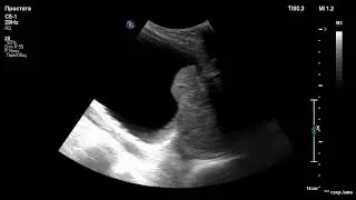 УЗИ. Аденома простаты. Prostate adenoma. BPH