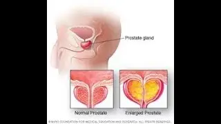 Enlarged Prostate