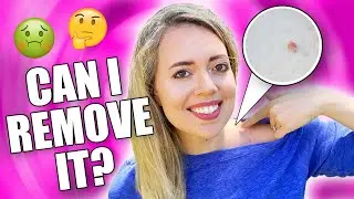 DIY Skin Tag REMOVAL- WILL IT WORK?