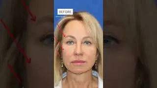 59 Year Old Woman LOOKS 20 YEARS YOUNGER! Flawless Facelift Transformation!