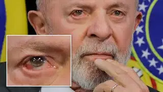 Urgente! DERR4ME CEREBR4L de LUL4 Confirmado: médicos preparam...