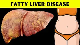 The Ultimate Guide to Understanding Fatty Liver Disease Everything You Should Know About Fatty Liver