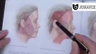 Liftingul facial