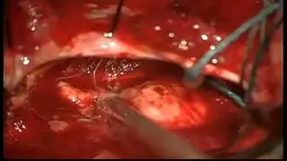 Tentorium infiltrated posterior fossa meningioma by Prof Dr Selçuk YILMAZLAR