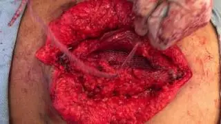 Mesh sutured repair abdominal wall with introducing needle