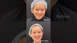 Hasil Rawatan Pigmentasi Dengan Dermamelan