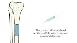 Bone Scaffolding