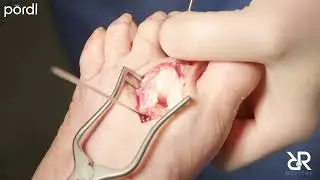 Dr. Randall Beckman’s Special Plantar Plate Repair