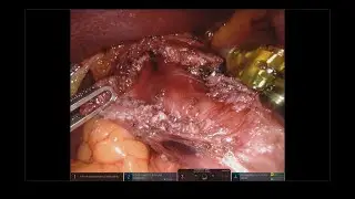 Robotic Heller-Dor Myotomy for Achalasia - Miotomia Robotica sec. Heller-Dor per Acalasia