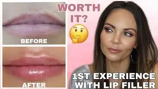 MY EXPERIENCE WITH LIP FILLER / INJECTIONS | 1ST 14 DAYS