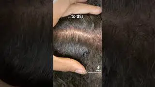 The #1 Solution for Scalp Psoriasis: No More Itchy Scalp! #scalppsoriasis #itchyscalp #psoriasis