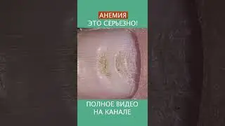 ТРЕВОЖНЫЕ ЗНАКИ АНЕМИИ - основные симптомы анемии! #shorts #анемия #гемоглобин #ферритин