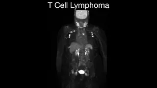 T Cell Lymphoma