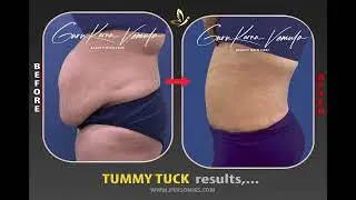 Transform Your Body with Tummy Tuck Surgery: Unbelievable 1-Year Results Await! | Personiks