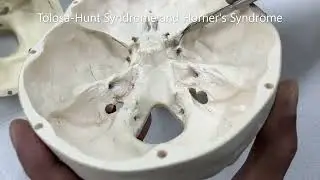 CRANIAL FOSSAE SKULL BASE FORAMINA Venous Sinuses Clinical Correlations – Sanjoy Sanyal
