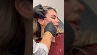 Threads reaction 🤯First time patient experiences PDO Threads for the first time!  #trending #viral