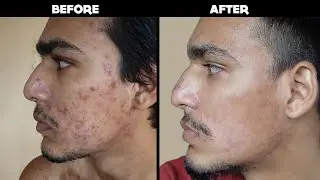 MY ACNE JOURNEY  (MOTIVATION/ACNE VIDEO)