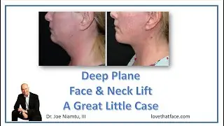 Deep Plane Face & Neck Lift: A Great Case