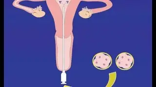 How is Embryo Transfer Performed? - Op. Dr. Emre Karatekelioğlu
