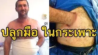 ปลูกมือ ในกระเพาะอาหาร เรื่องน่าทึ่ง จาก บราซิล