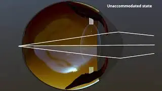 Accommodation in the Human Eyeball