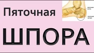 Копеечное средство от ПЯТОЧНОЙ ШПОРЫ. Болит пятка. Полная схема лечения