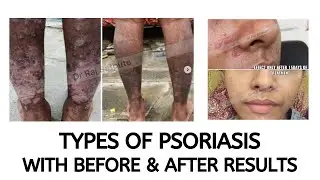 Types of Psoriasis (with before & after results) | How to Cure Psoriasis | Psoriasis Treatment