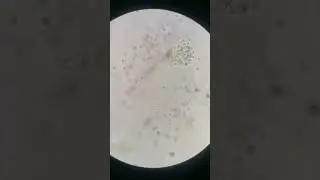 Urine sediments:WBCs -White Blood Cells seen in clumps 