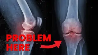 KNEE PAIN leads to a SHOCKING DIAGNOSIS