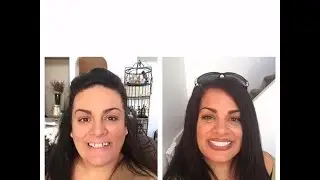 My Snap In Denture Journey in Mexico All My Teeth were EXTRACTED