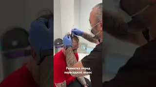 Разметка, далее бритье, анестезия и пересадка. Больше в нашем insta 
