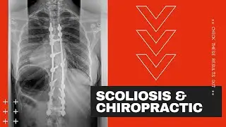 ** GIRL WITH SCOLIOSIS AND FUSION and CHIROPRACTIC CARE **
