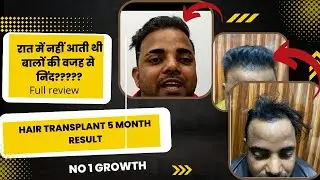 रात में नहीं आती थी बालों की वजह से निंद ?Hair transplant result | Review after new look | 📍Delhi