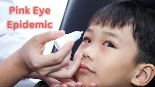 Eye Flu | Pink Eye | Conjunctivitis