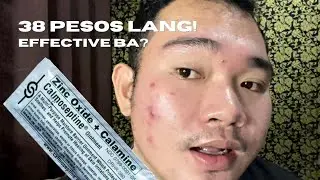 How To Dry Pimples in 1 DAY| Affordable Acne Treatment