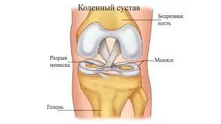 Несколько тестов для оценки работы мениска. (Коленный сустав)