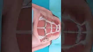 Абдоминопластика: Плюсы и Реабилитация ✨