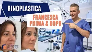 Rinosettoplastica: Francesca Prima e Dopo!