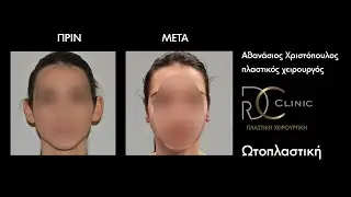 Ωτοπλαστική