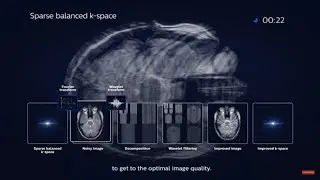 Philips Compressed SENSE - how does it work?