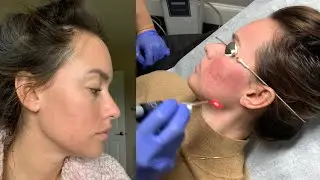 Treating Acne Scarring With A Fotofacial! VLOGMAS DAY 2