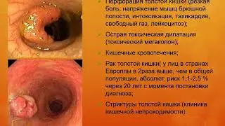 Дифференциальный диагноз при заболеваниях толстого кишечника